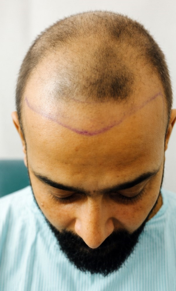 Scalp before hair transplant treatment at Dexa Clinic